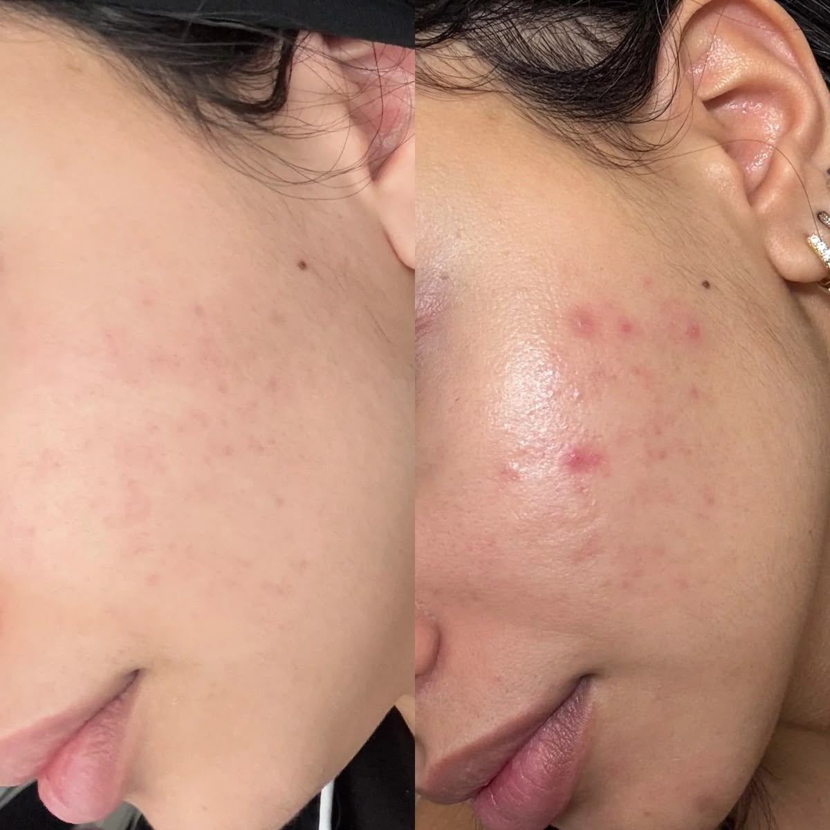 Anti Acne Serum