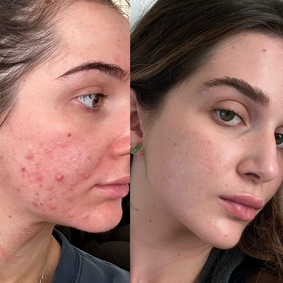 Anti Acne Serum