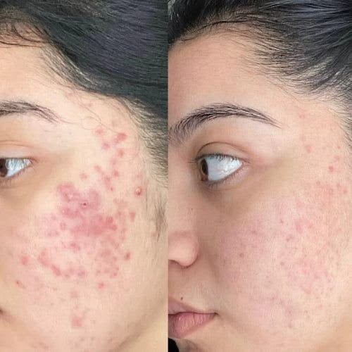 Anti Acne Serum