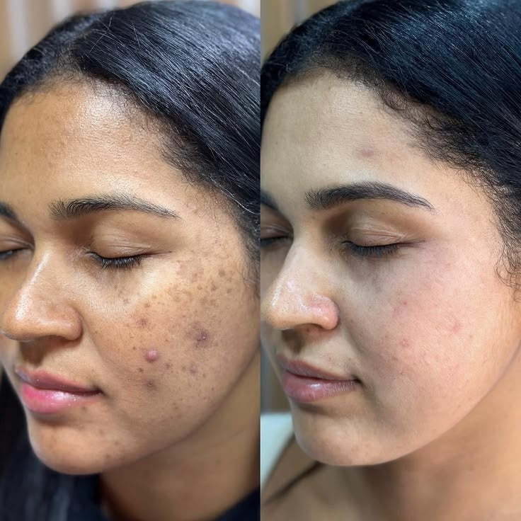 Anti Acne Serum